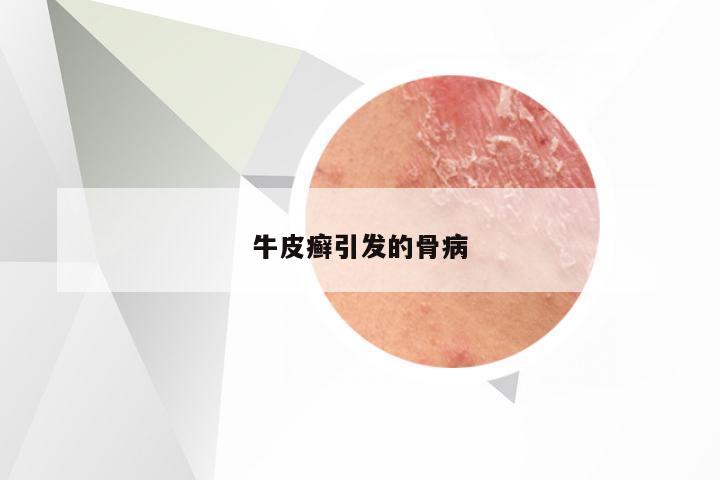 牛皮癣引发的骨病