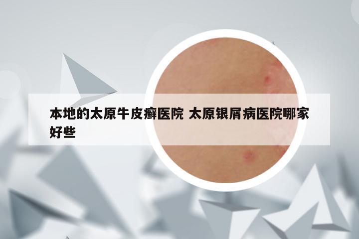 本地的太原牛皮癣医院 太原银屑病医院哪家好些