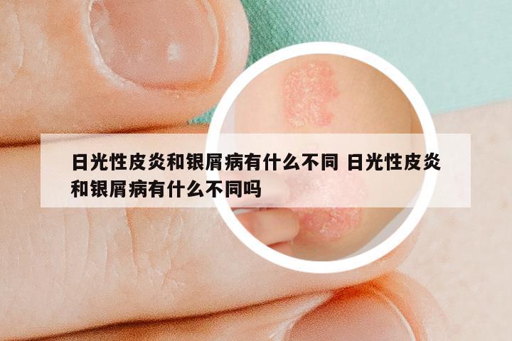 日光性皮炎和银屑病有什么不同 日光性皮炎和银屑病有什么不同吗