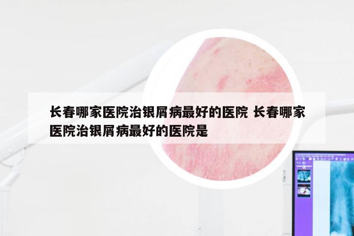长春哪家医院治银屑病最好的医院 长春哪家医院治银屑病最好的医院是
