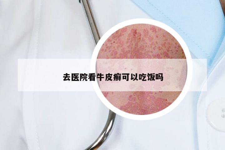 去医院看牛皮癣可以吃饭吗