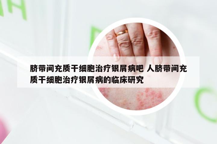 脐带间充质干细胞治疗银屑病吧 人脐带间充质干细胞治疗银屑病的临床研究