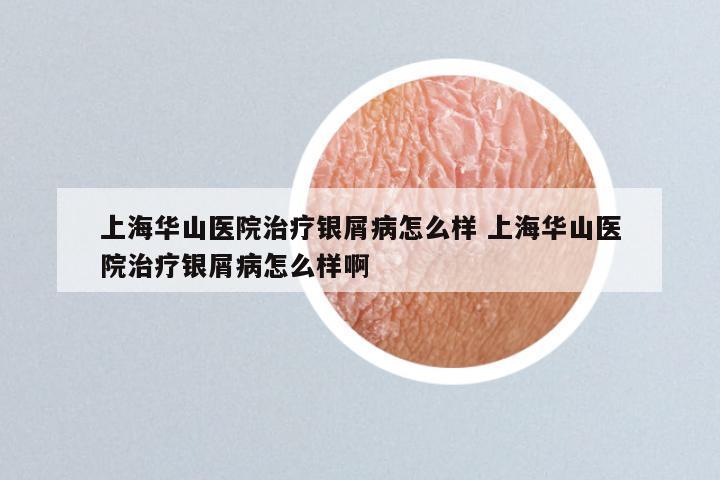 上海华山医院治疗银屑病怎么样 上海华山医院治疗银屑病怎么样啊