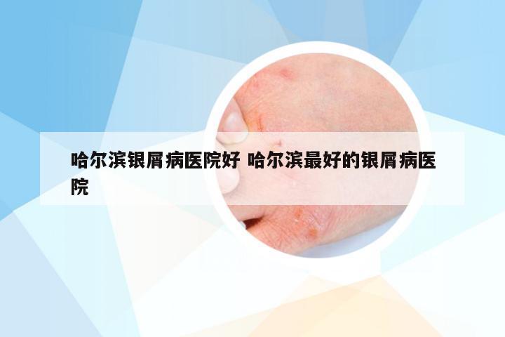 哈尔滨银屑病医院好 哈尔滨最好的银屑病医院