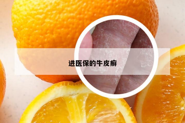 进医保的牛皮癣
