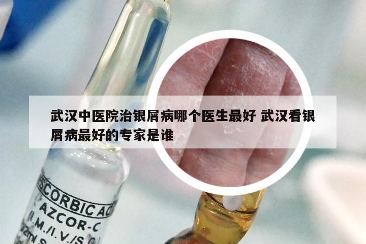 武汉中医院治银屑病哪个医生最好 武汉看银屑病最好的专家是谁