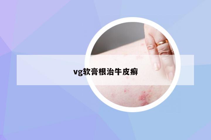 vg软膏根治牛皮癣