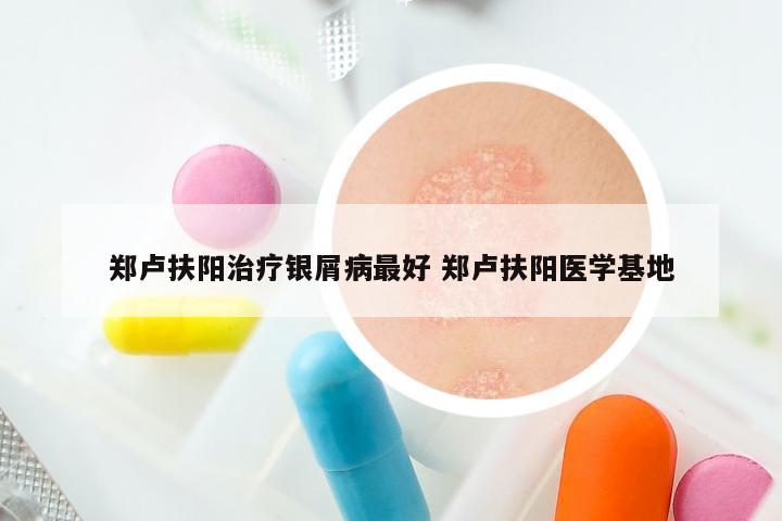 郑卢扶阳治疗银屑病最好 郑卢扶阳医学基地