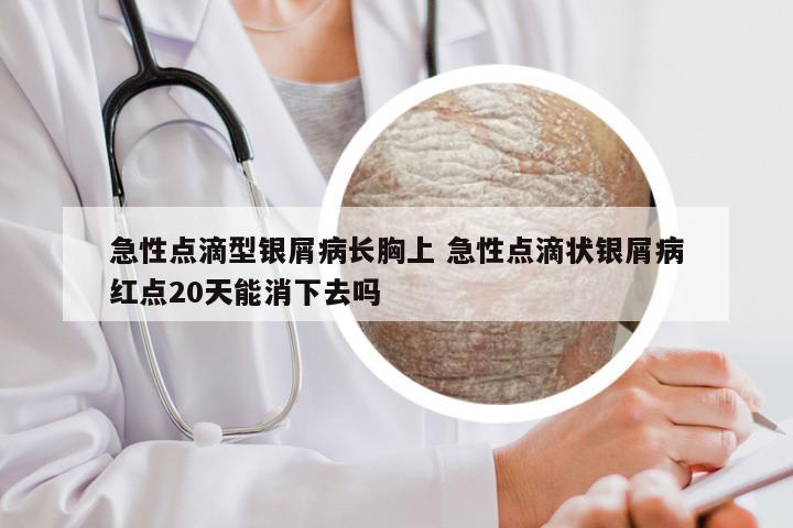 急性点滴型银屑病长胸上 急性点滴状银屑病红点20天能消下去吗