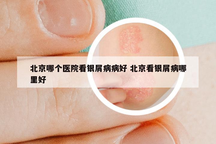 北京哪个医院看银屑病病好 北京看银屑病哪里好