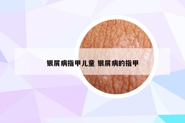 银屑病指甲儿童 银屑病的指甲