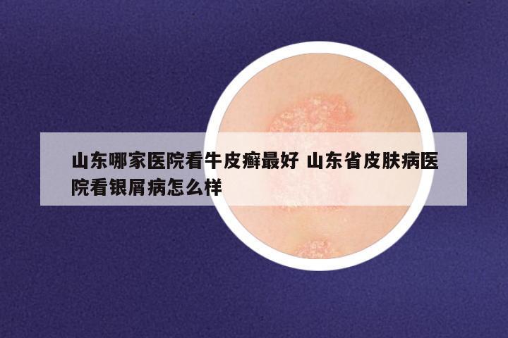 山东哪家医院看牛皮癣最好 山东省皮肤病医院看银屑病怎么样