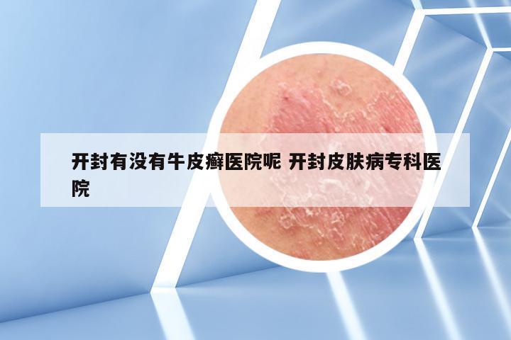 开封有没有牛皮癣医院呢 开封皮肤病专科医院