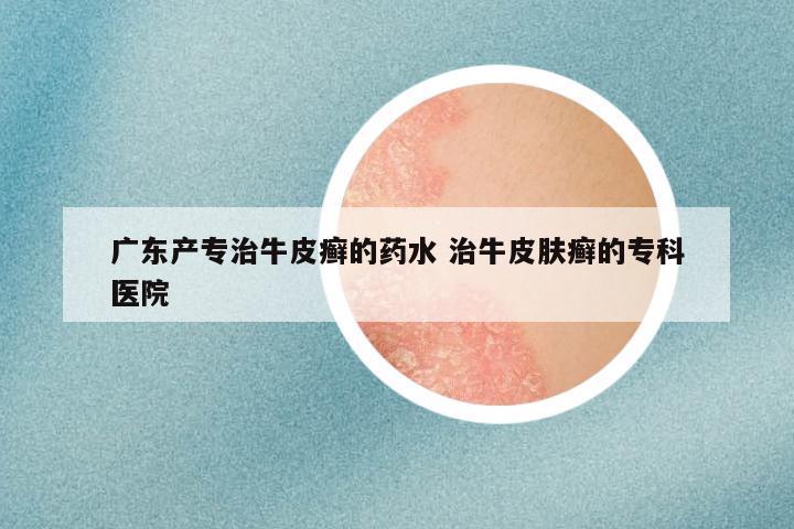 广东产专治牛皮癣的药水 治牛皮肤癣的专科医院