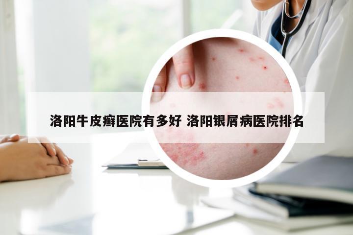 洛阳牛皮癣医院有多好 洛阳银屑病医院排名