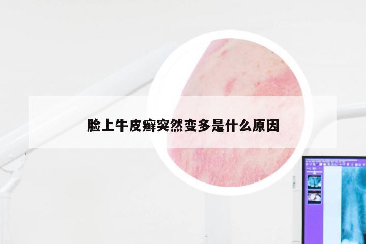 脸上牛皮癣突然变多是什么原因