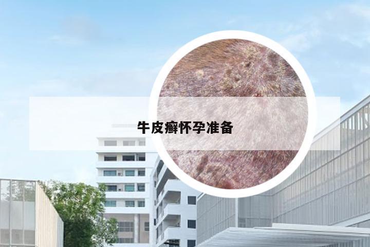 牛皮癣怀孕准备