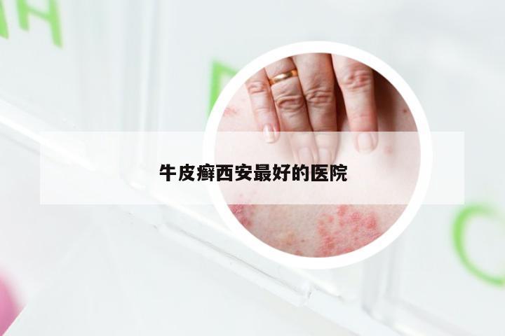 牛皮癣西安最好的医院
