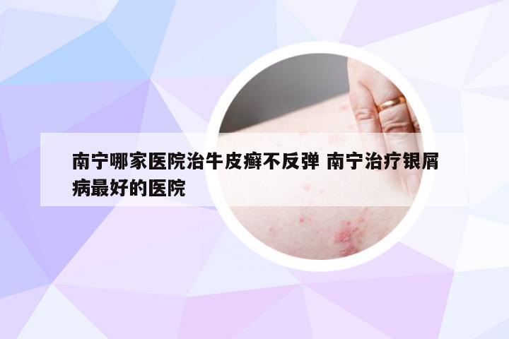 南宁哪家医院治牛皮癣不反弹 南宁治疗银屑病最好的医院