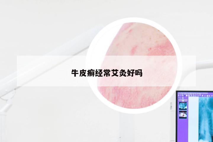 牛皮癣经常艾灸好吗