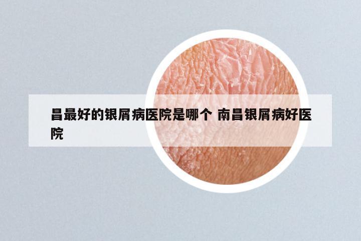 昌最好的银屑病医院是哪个 南昌银屑病好医院