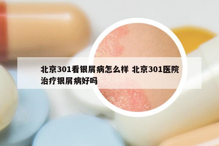 北京301看银屑病怎么样 北京301医院治疗银屑病好吗