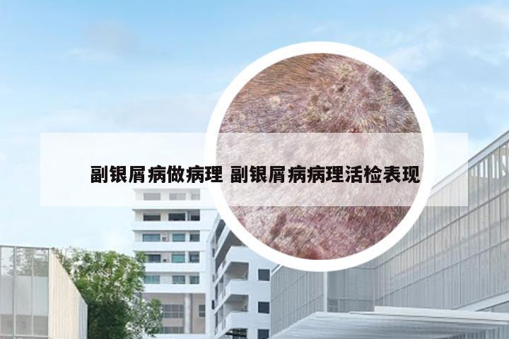 副银屑病做病理 副银屑病病理活检表现