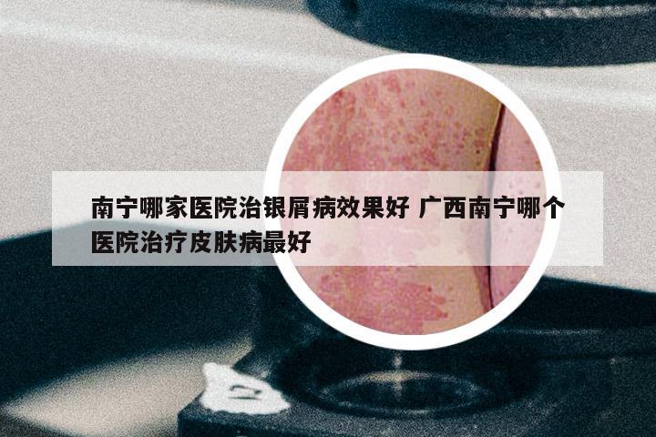 南宁哪家医院治银屑病效果好 广西南宁哪个医院治疗皮肤病最好