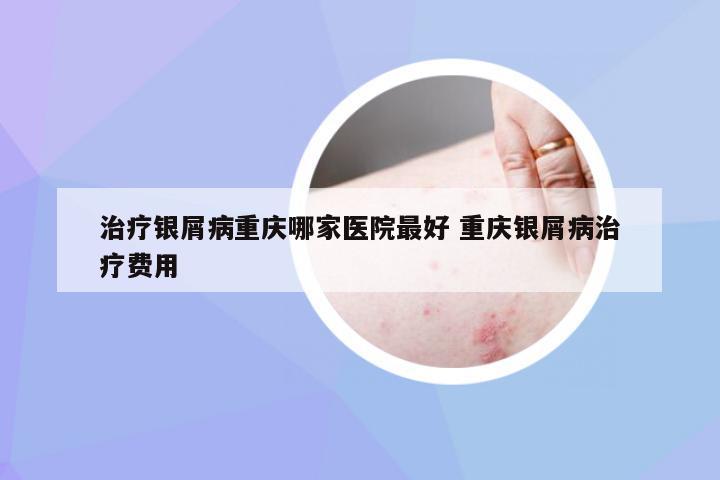 治疗银屑病重庆哪家医院最好 重庆银屑病治疗费用