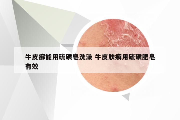 牛皮癣能用硫磺皂洗澡 牛皮肤癣用硫磺肥皂有效
