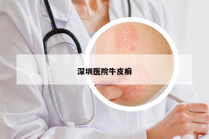 深圳医院牛皮癣