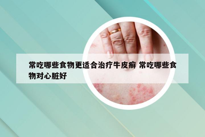 常吃哪些食物更适合治疗牛皮癣 常吃哪些食物对心脏好