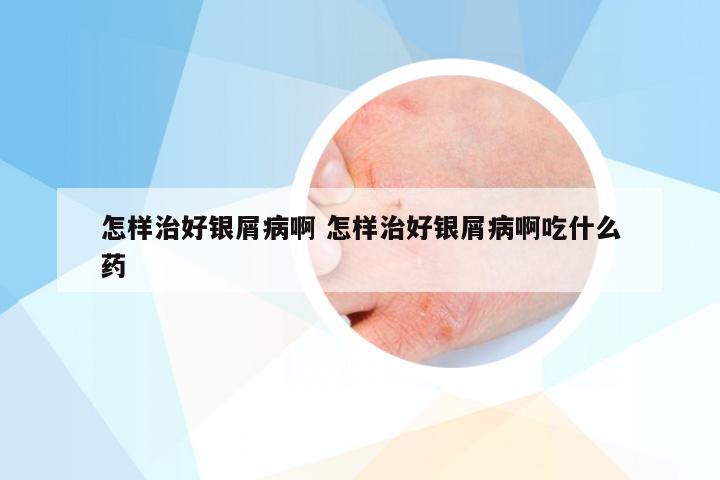 怎样治好银屑病啊 怎样治好银屑病啊吃什么药