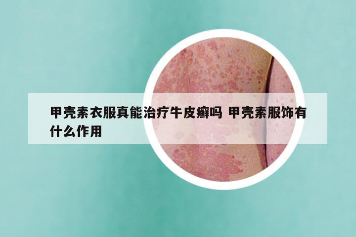 甲壳素衣服真能治疗牛皮癣吗 甲壳素服饰有什么作用