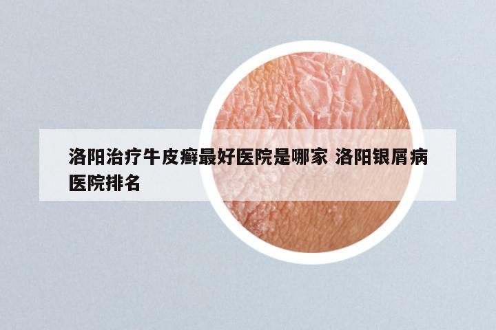 洛阳治疗牛皮癣最好医院是哪家 洛阳银屑病医院排名