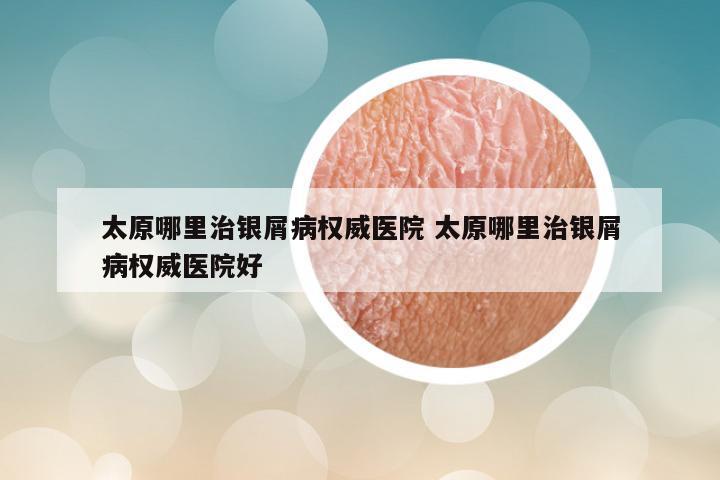 太原哪里治银屑病权威医院 太原哪里治银屑病权威医院好