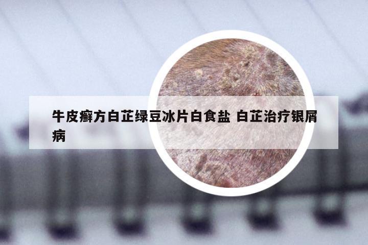 牛皮癣方白芷绿豆冰片白食盐 白芷治疗银屑病