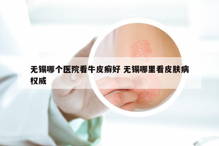 无锡哪个医院看牛皮癣好 无锡哪里看皮肤病权威