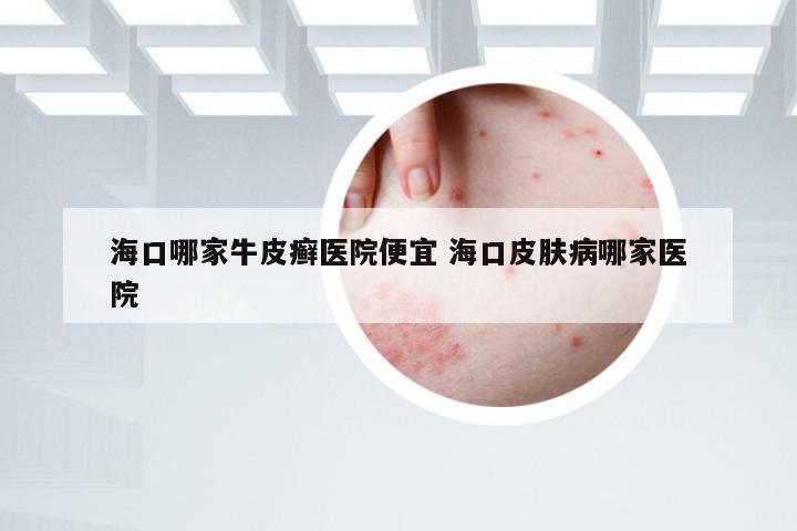 海口哪家牛皮癣医院便宜 海口皮肤病哪家医院