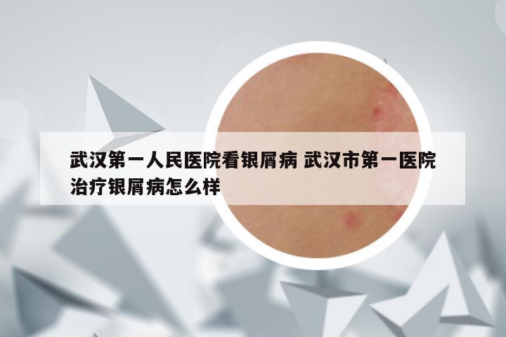 武汉第一人民医院看银屑病 武汉市第一医院治疗银屑病怎么样