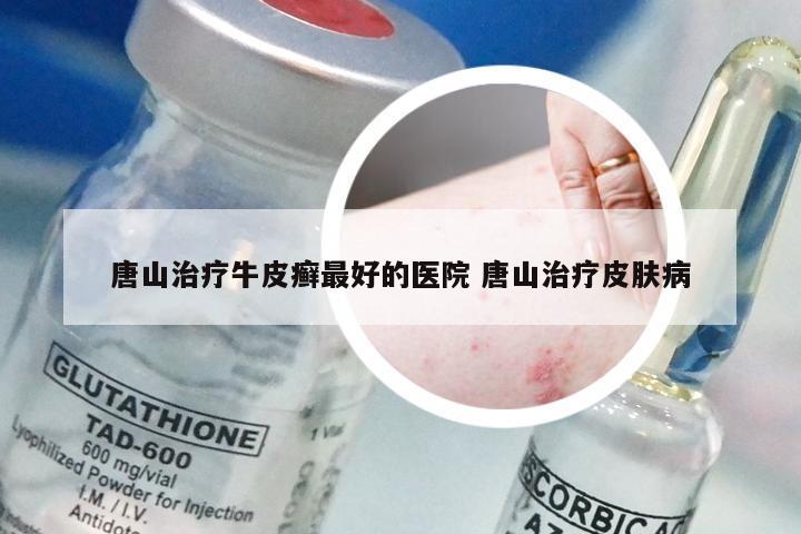 唐山治疗牛皮癣最好的医院 唐山治疗皮肤病