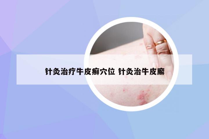 针灸治疗牛皮癣穴位 针灸治牛皮廨