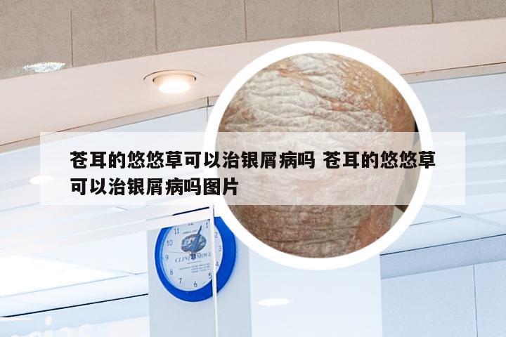 苍耳的悠悠草可以治银屑病吗 苍耳的悠悠草可以治银屑病吗图片