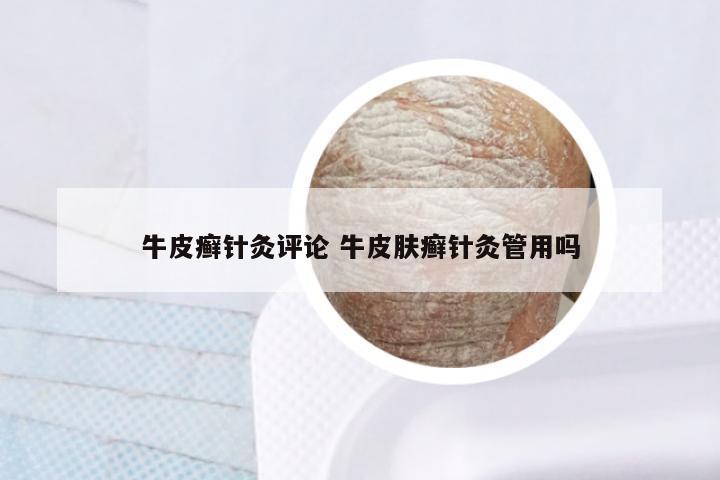 牛皮癣针灸评论 牛皮肤癣针灸管用吗