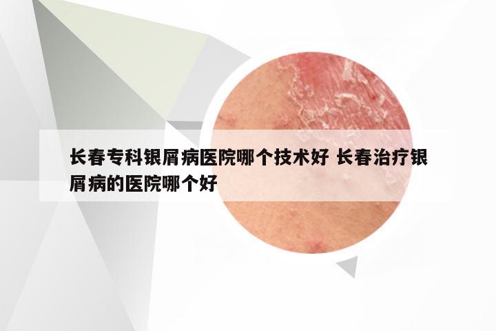 长春专科银屑病医院哪个技术好 长春治疗银屑病的医院哪个好