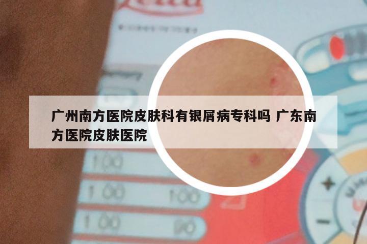 广州南方医院皮肤科有银屑病专科吗 广东南方医院皮肤医院