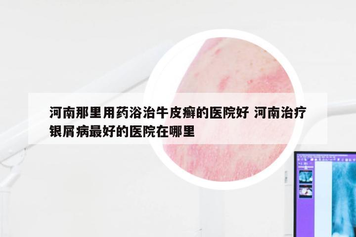 河南那里用药浴治牛皮癣的医院好 河南治疗银屑病最好的医院在哪里