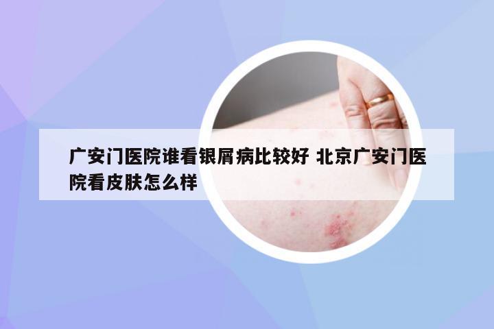 广安门医院谁看银屑病比较好 北京广安门医院看皮肤怎么样