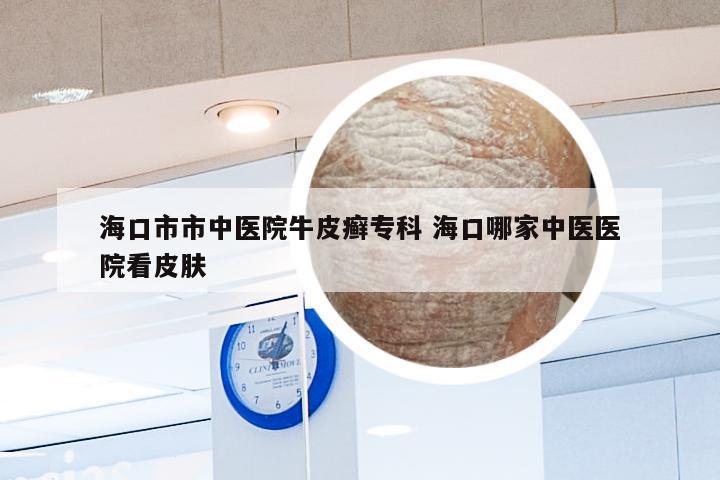 海口市市中医院牛皮癣专科 海口哪家中医医院看皮肤