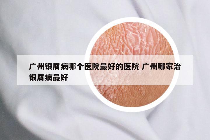 广州银屑病哪个医院最好的医院 广州哪家治银屑病最好
